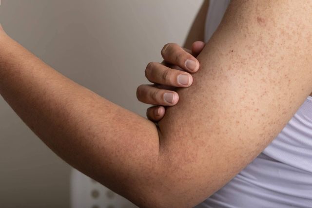 Cómo mitigar los síntomas de la queratosis pilaris, por la Dra. Janeth Arévalo - 1, Foto 1