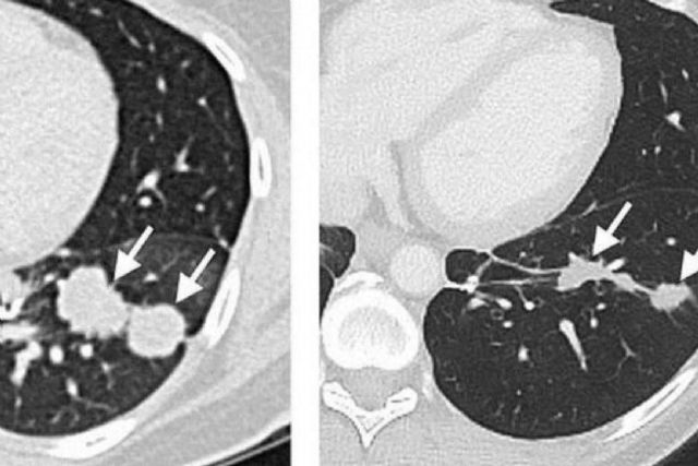 Oncovix; Inmunoterapia de Precisión, un Hito en la Revolución del Tratamiento del Cáncer - 1, Foto 1