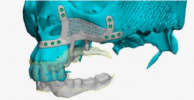 El Dr. Montesdeoca reconstruye el hueso maxilar superior gracias a unos implantes dentales subperiósticos - 1, Foto 1