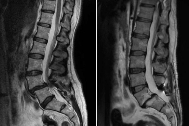 El Dr. Botella-Asunción habla sobre la Espondilolistesis Lumbar - 1, Foto 1