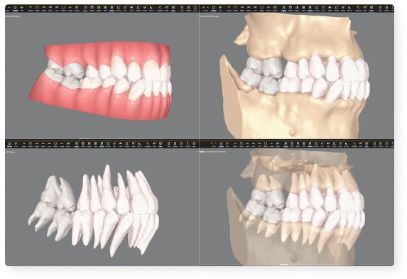 Align technology lanza nuevas innovaciones del sistema invisalign - 2, Foto 2