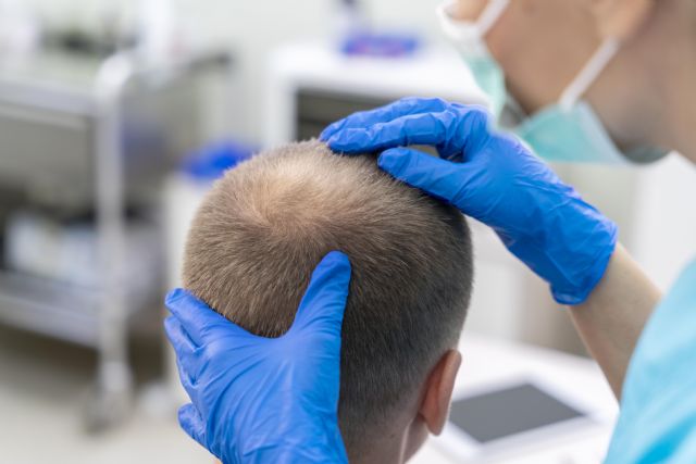 El 50% de la población española padece alopecia, y de ellos, un 90% es de carácter androgénico - 1, Foto 1