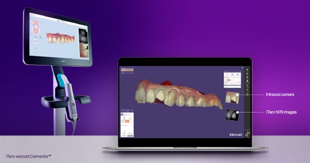 Align Technology presenta la última versión del software iTero-exocad Connector™ - 1, Foto 1