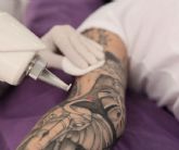 Eliminación de tatuajes