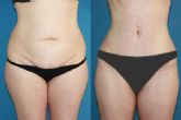 Abdominoplastia Tulua HD, lo ltimo en ciruga esttica para corregir el abdomen y crear un nuevo ombligo