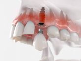 La tcnica por la que apuesta Clnica Dental Sonrisas para conseguir una dentadura de 10 en sus pacientes, implantes postextraccin con carga inmediata