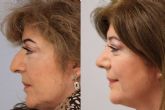 Qu hacer antes de pasar por una rinoplastia ultrasnica, por el Dr. Prez Villar