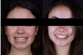 ?Cules son las ventajas de las carillas dentales?, por los profesionales de Carillas WikendR