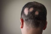 Combatir la alopecia areata con Saw Palmetto y su tratamiento