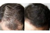 Tratamientos efectivos para alopecia androgentica en Innovacin Capilar