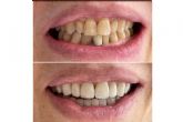 Todo lo que se debe saber acerca de las microcarillas dentales, por Clnica MG Dental & Esttica Facial