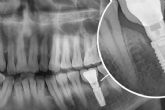 Implantes dentales en la clnica dental del Dr. Romn Hernndez para recuperar la funcionalidad de la boca