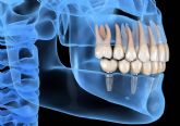 La Clnica Dental de la Doctora Cachero ofrece implantes dentales