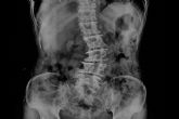 Las principales causas y tratamientos de la escoliosis lumbar