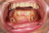 Implantes dentales en los casos ms complicados, de la mano de Centro Nacional de Ciruga Bucomaxilofacial e Implantes