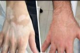 Dermopigmentacin Clnica dispone del TERAV tratamiento esttico de repigmentacin artificial para vitiligo