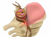 Medicina regenerativa en hernia discal: detrs de la curacin mediante la respuesta inmunolgica