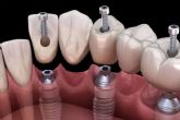 ?Dnde encontrar un servicio de colocacin de implantes? Dental Implantologie