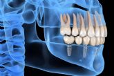 Recuperar la mejor versin de la sonrisa con los implantes dentales inmediatos de DeltaDent