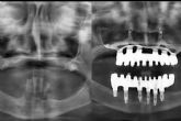 La Clnica Calvo de Mora en Madrid cuenta con expertos en implantes dentales