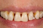 ?Cmo tratar la gingivitis?, con Clnica Dental Ruiz de Gopegui