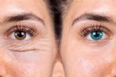 Blefaroplastia con lser sin ciruga, una opcin saludable, poco invasiva y efectiva