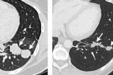 Oncovix; Inmunoterapia de Precisin, un Hito en la Revolucin del Tratamiento del Cncer