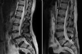 El Dr. Botella-Asuncin habla sobre la Espondilolistesis Lumbar