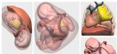 Tecnología 3D española de Cella ayuda a tratar una inusual y compleja lesión torácica en un feto