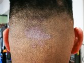 Tinea capitis, una infección del cuero cabelludo en ascenso en España desde el año 2021