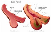 La SEEN promueve en el Da Nacional de la Fibrosis Qustica la creacin de unidades multidisciplinares